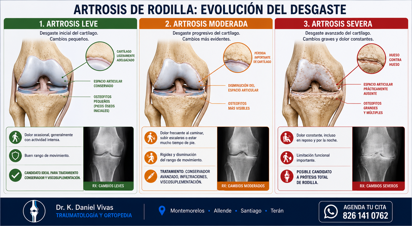 Evolución de la artrosis de rodilla: leve, moderada y severa
