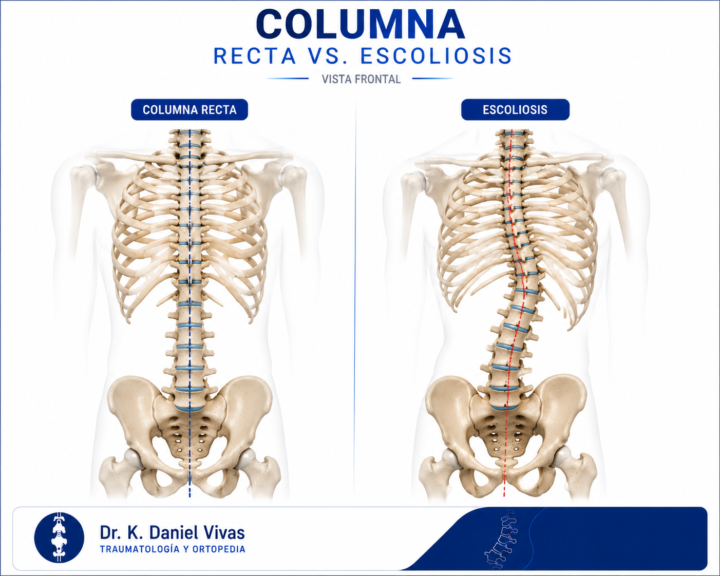 Columna recta sana vs columna con escoliosis, vista frontal