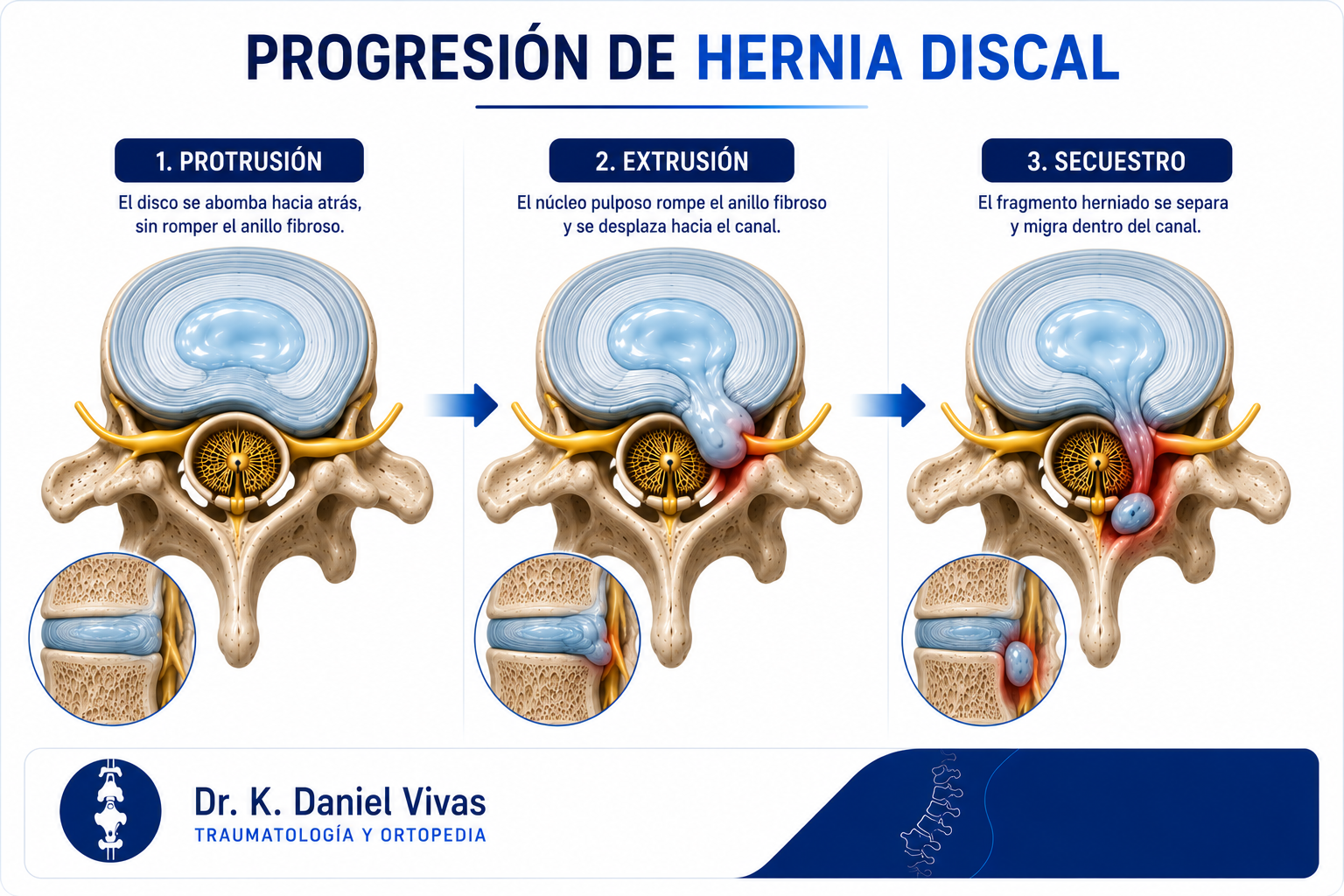 Progresión de hernia discal: protrusión, extrusión y secuestro discal