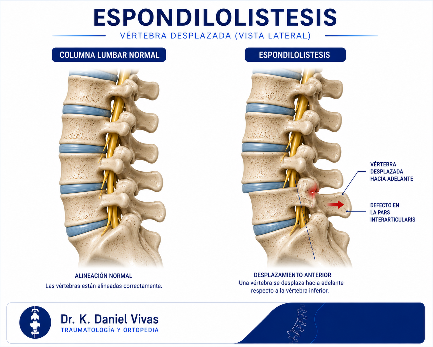 Espondilolistesis: vértebra lumbar desplazada hacia adelante comparada con alineación normal, vista lateral