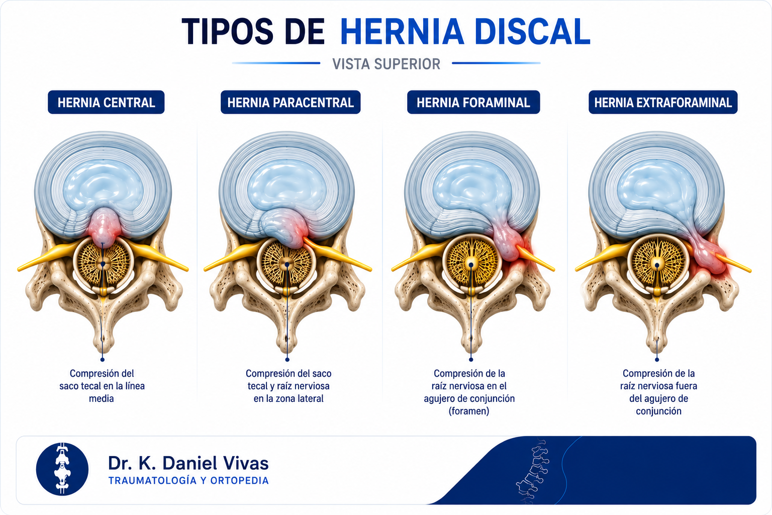 Tipos de hernia discal en vista superior: central, paracentral, foraminal y extraforaminal