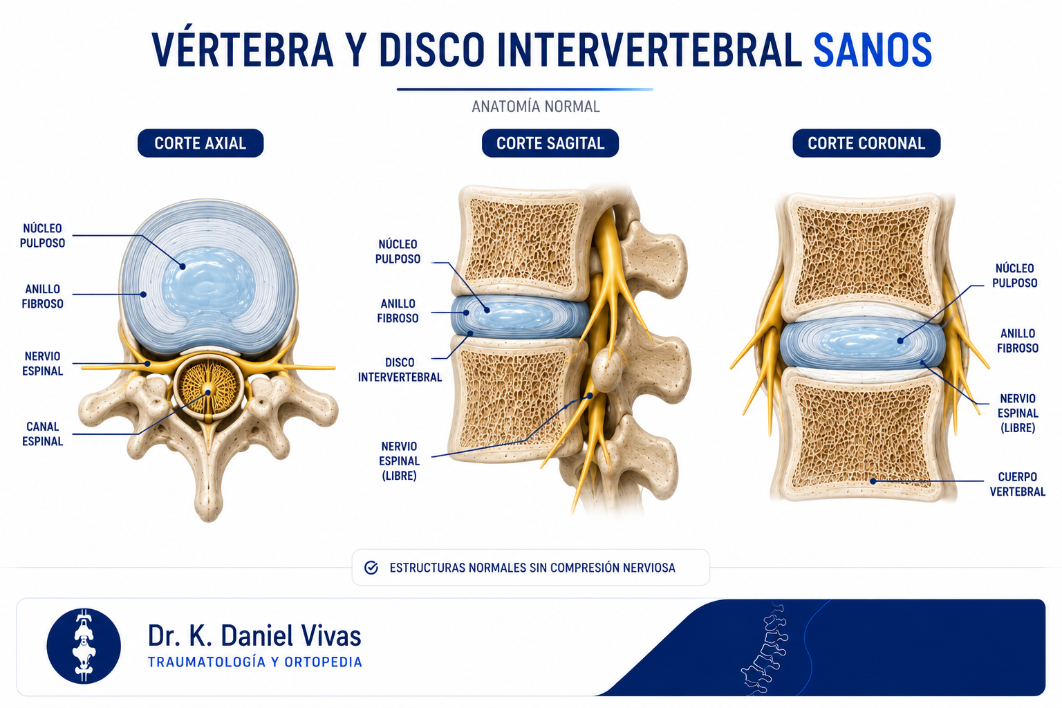 Vértebra y disco sanos en tres cortes: axial, sagital y coronal, sin compresión nerviosa