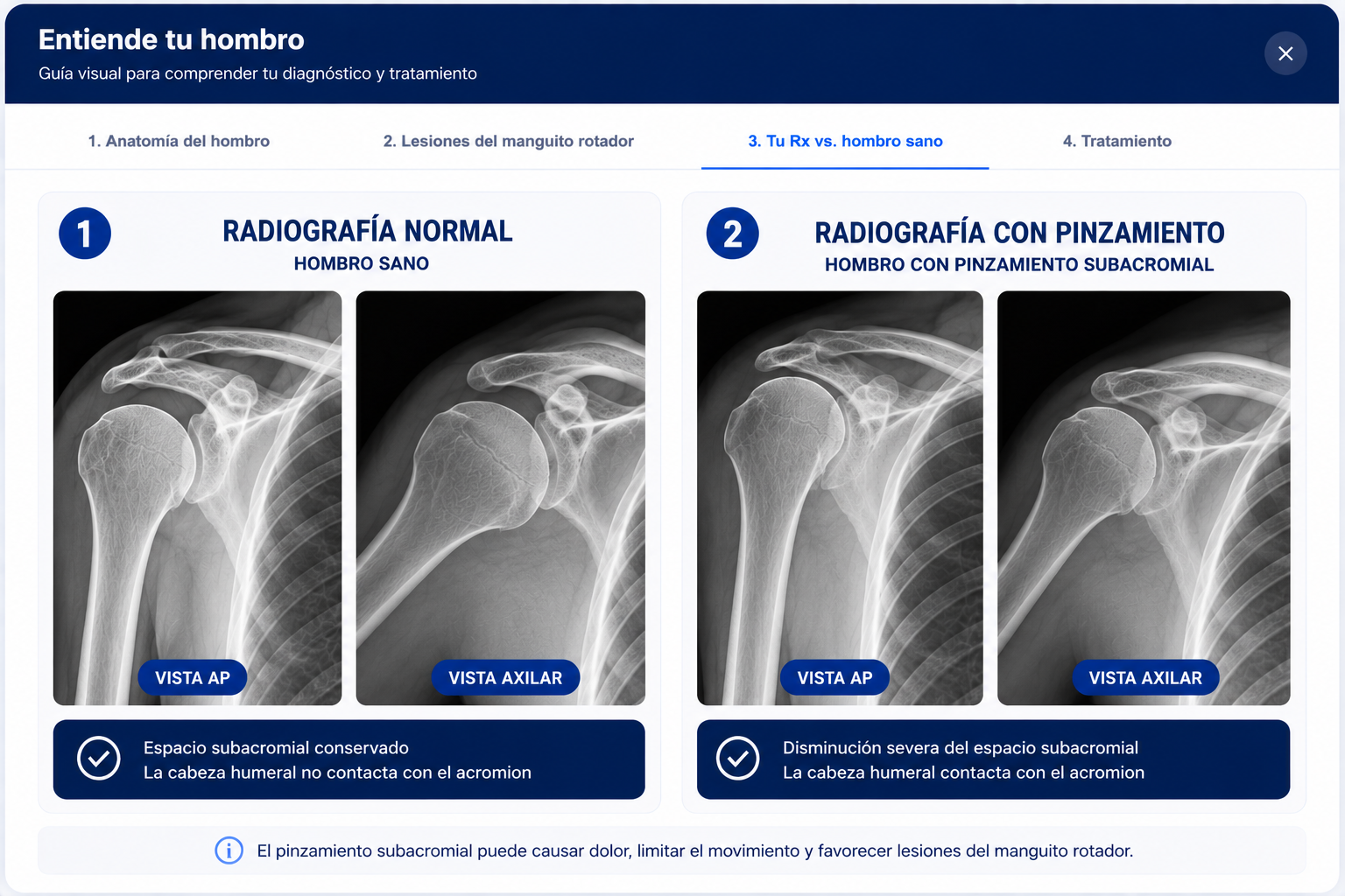 Problemas comunes del hombro — tendinitis, desgarro, impingement
