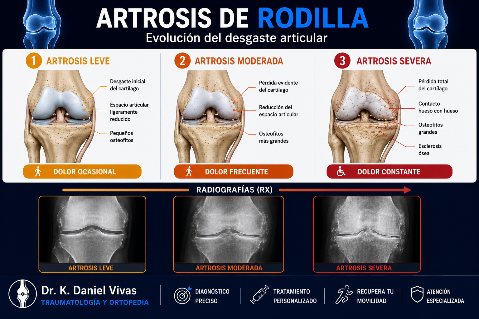 Evolución de la artrosis de rodilla: leve, moderada y severa